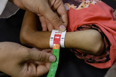 "الصحة العالمية": سوء التغذية لا يزال يمثل مشكلة صحية خطيرة في غزة