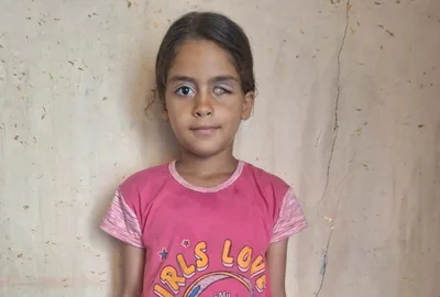 الطفلة فاطمة بين خيمة النزوح وغرف العمليات 